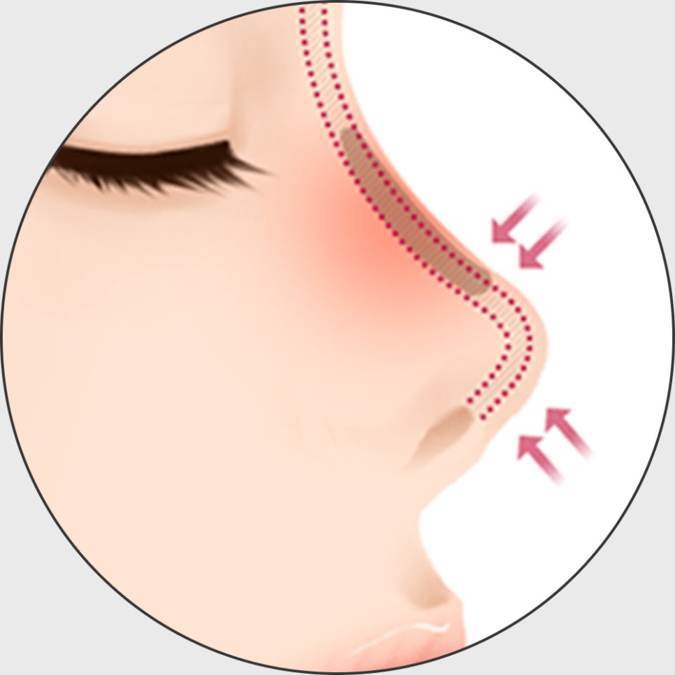 코 재수술, 적합한 시기에 원인에 따른 올바른 방법으로 개선해야 합니다! 관련 이미지 4