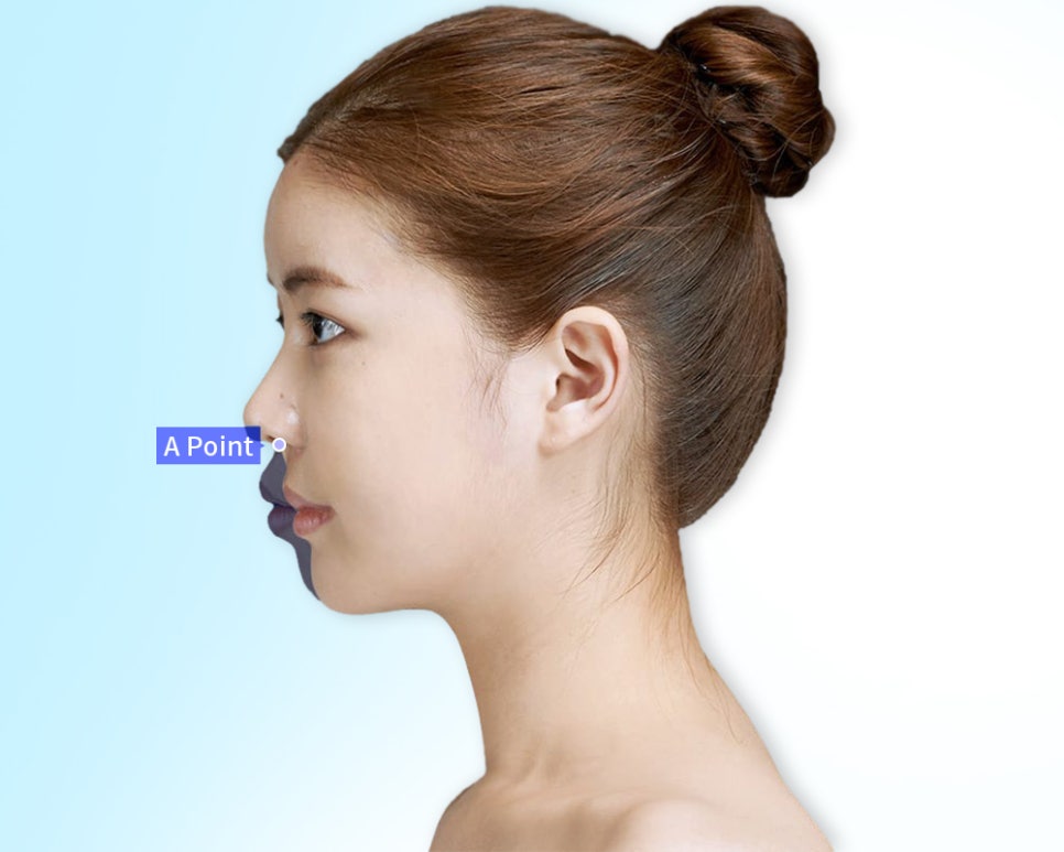 유형에 따라 달라지는 돌출입 수술 방법 관련 이미지 6