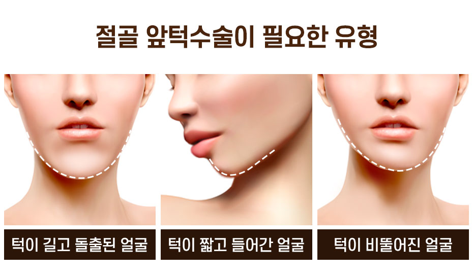 황금비율이란? 앞턱에 따라 달라지는 얼굴 비율 관련 이미지 3