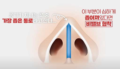 비밸브협착증, 코 막힘의 원인은? 관련 이미지 3