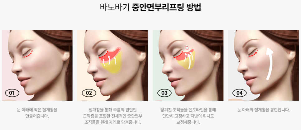 탄탄한 입체감으로 더욱 화사하게! 중안면부 리프팅 관련 이미지 3