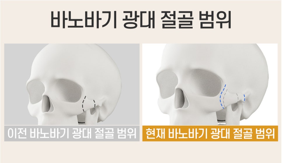 얼굴에 어울리는 광대의 모양을 살리는 광대축소술의 핵심! 관련 이미지 2
