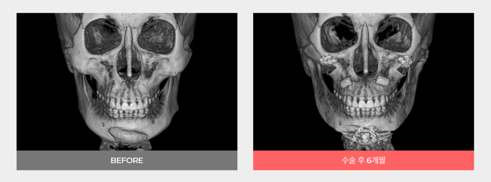 안면윤곽재수술 정답은 바노바기입니다! 관련 이미지 4