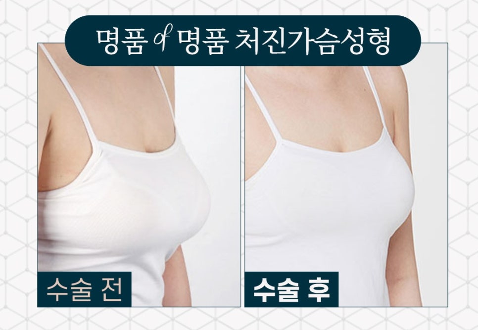 가슴처짐수술 회복과 흉터에 더욱 신경 써야 합니다. 관련 이미지 7