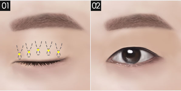 남자 눈 성형, 자연스럽고 또렷한 인상으로! 관련 이미지 5