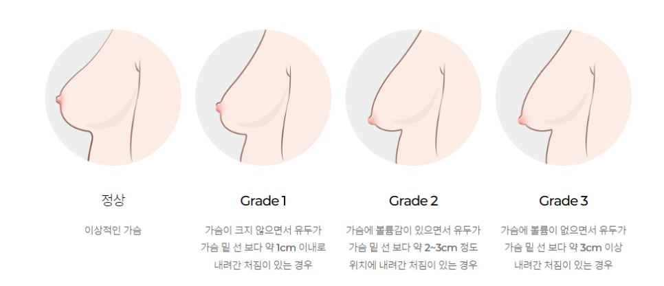 가슴처짐수술 회복과 흉터에 더욱 신경 써야 합니다. 관련 이미지 3