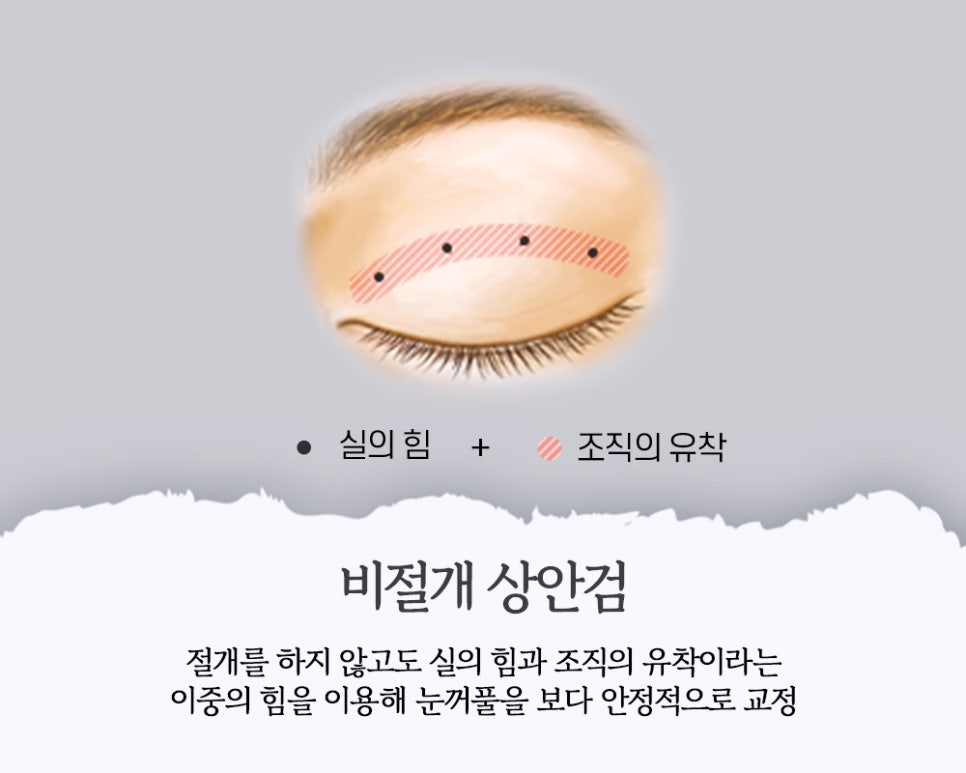상안검, 미용적 기능적 문제 동시에 개선해 동안 눈매로 관련 이미지 5
