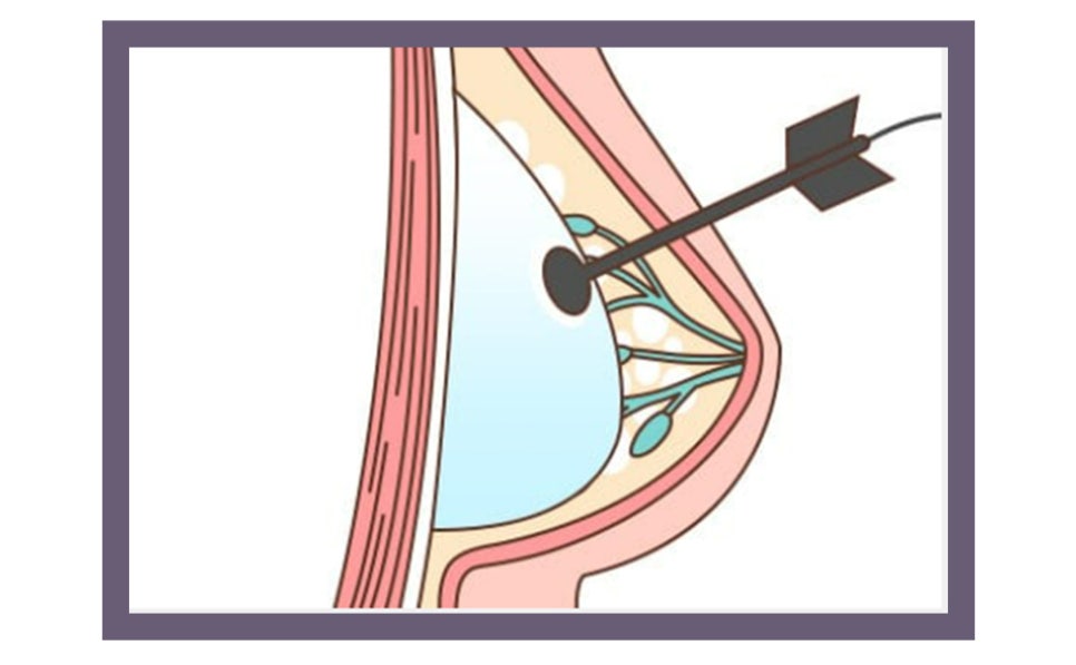 유방암 치료 후 가슴 재건 시기와 수술 방법 관련 이미지 6
