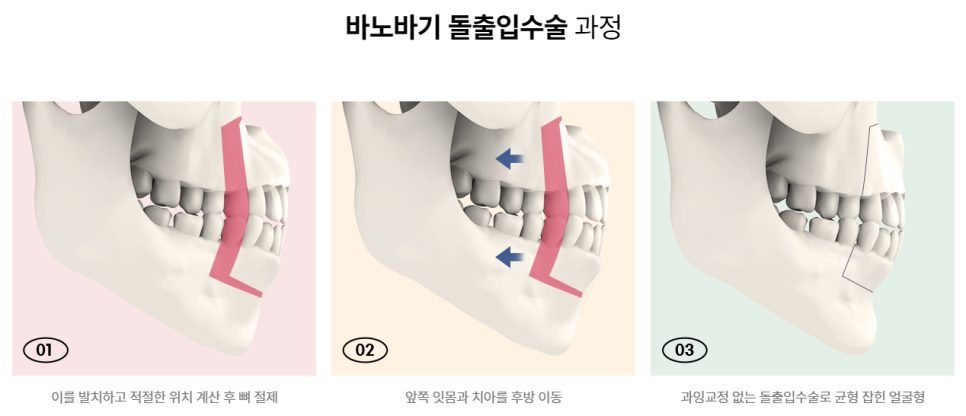 돌출 입, 쏙 집어넣는 방법! 관련 이미지 5