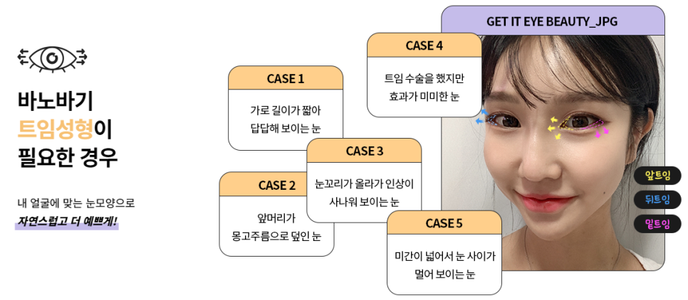 내 눈의 숨겨진 1mm를 찾아내다! 바노바기 트임성형 관련 이미지 2