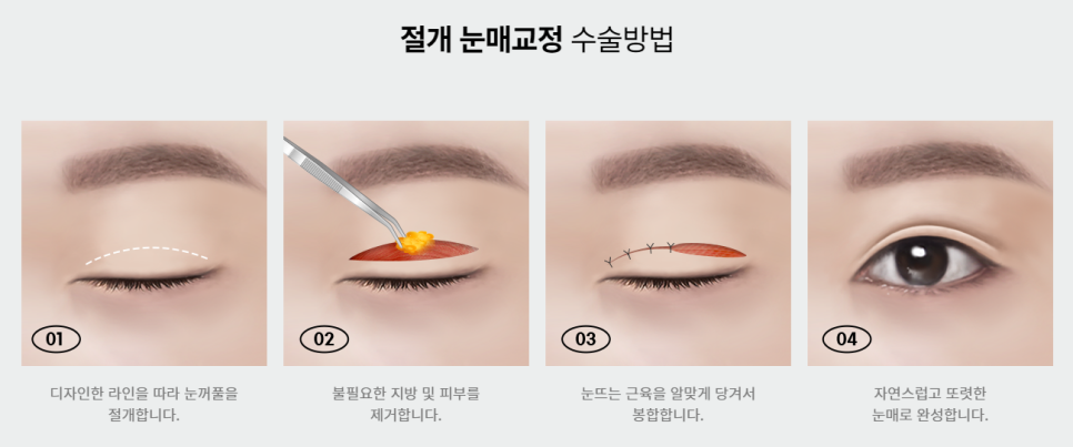 답답한 눈, 눈매교정으로 뚜렷하게! 관련 이미지 5