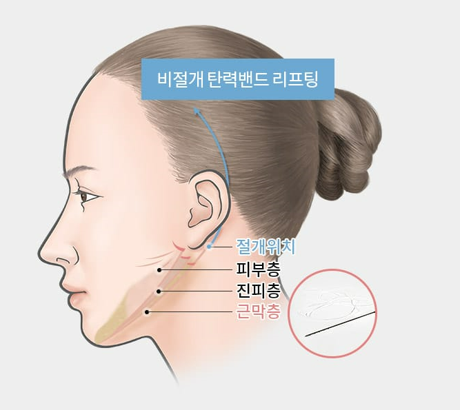 탄력밴드 리프팅으로 더 오래가는 자연스러운  젊음 관련 이미지 5