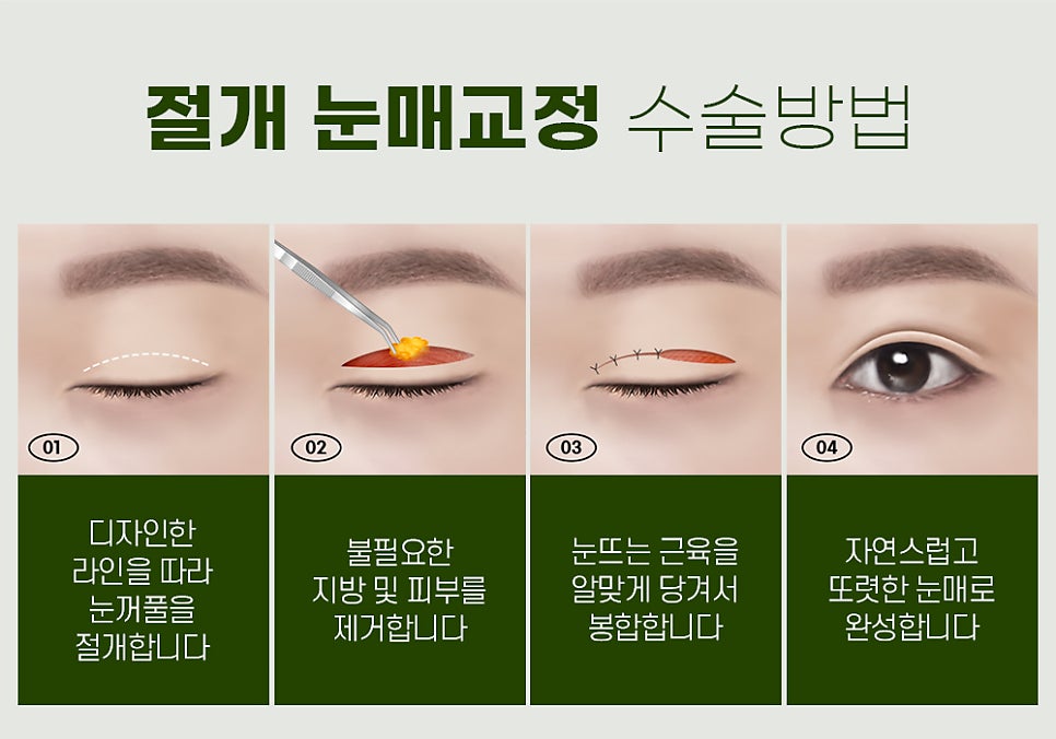 눈매교정 수술법, 절개 vs 비절개 나에게 맞는 수술법은? 관련 이미지 7