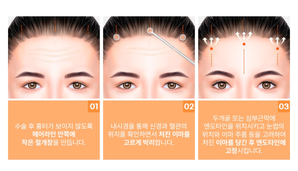 이마 주름, 미간 주름, 눈꺼풀 처짐! 내시경 엔도타인 이마 리프팅으로 개선하실 수 있습니다. 관련 이미지 3