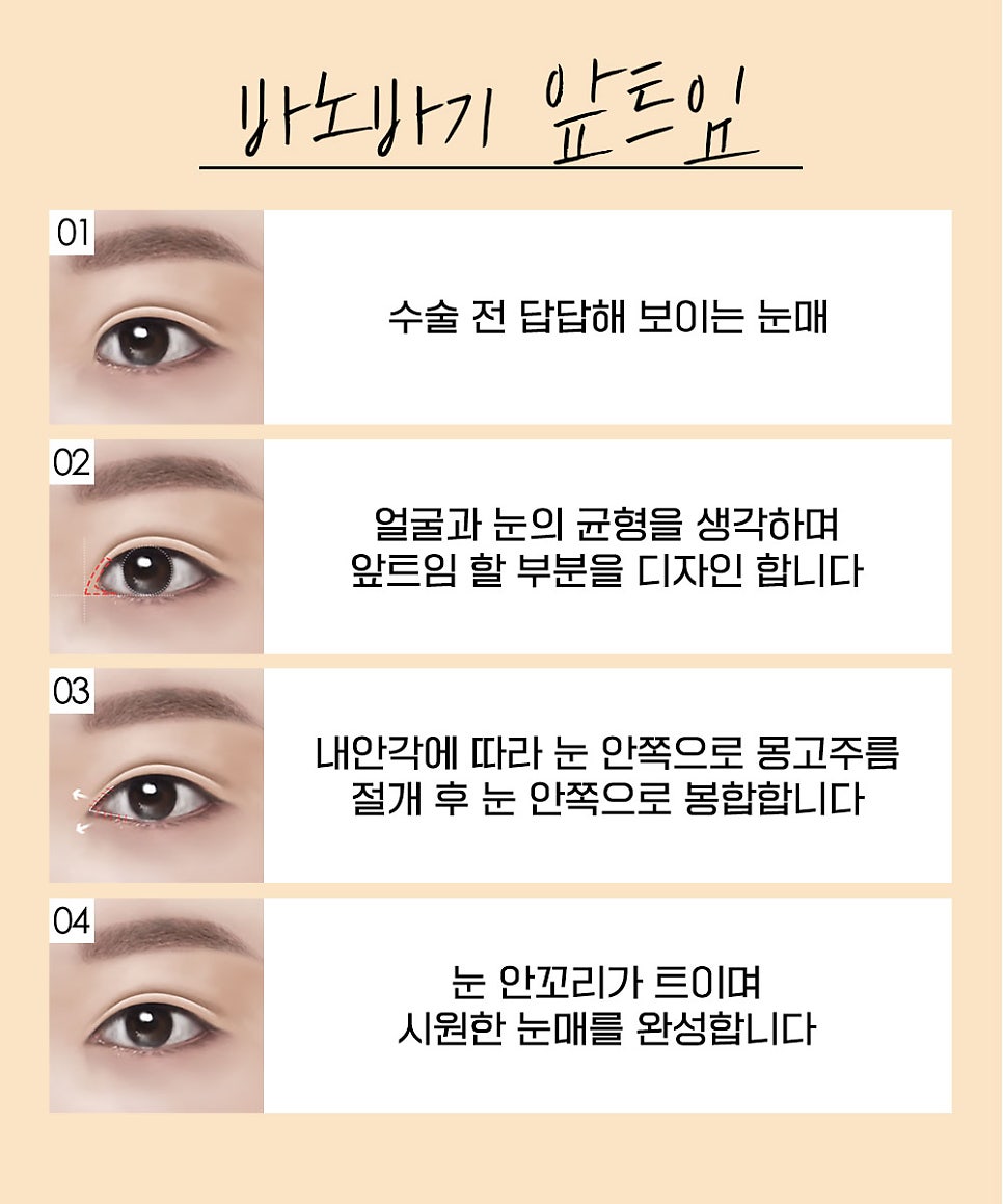 트임  성형, 얼굴에 맞는 조화로운 눈의 비율과 시원한 눈매로 개선 관련 이미지 3