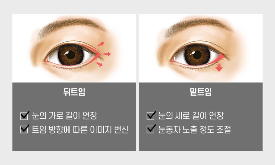 답답한 눈매를 또렷하고 시원하게 개선할 수 있는 트임 성형 방법! 관련 이미지 6