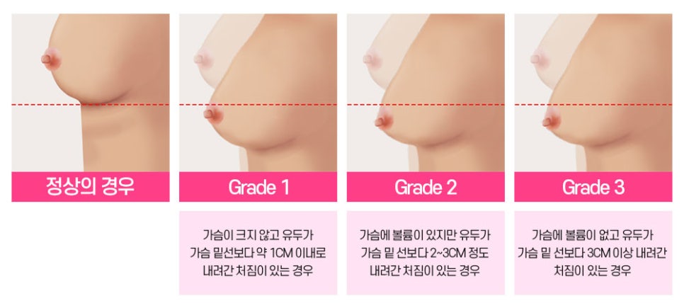 나도 처진 가슴일까? 유형에 따른 수술법과 개선 방법 관련 이미지 5