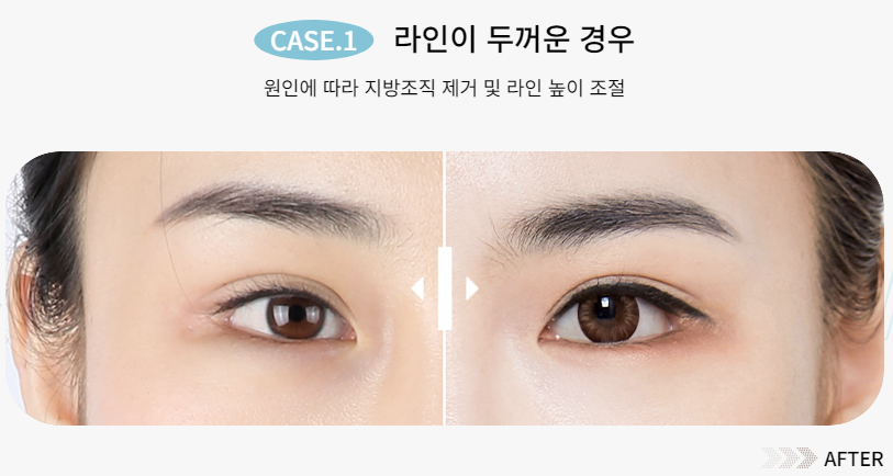 예쁜 눈매를 되찾는 방법, 눈 재수술 관련 이미지 3