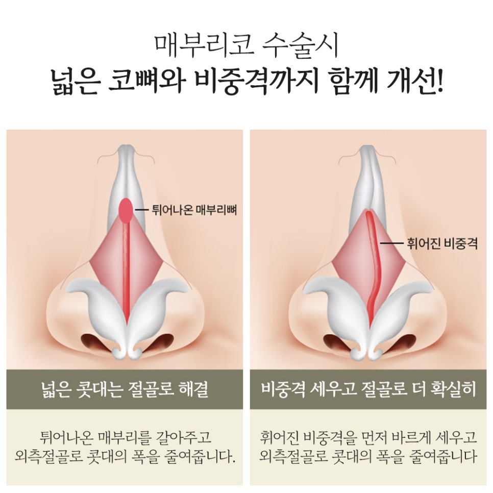 굴곡진 콧대, 매부리코 성형으로 자연스럽고 매끄럽게 개선 관련 이미지 2