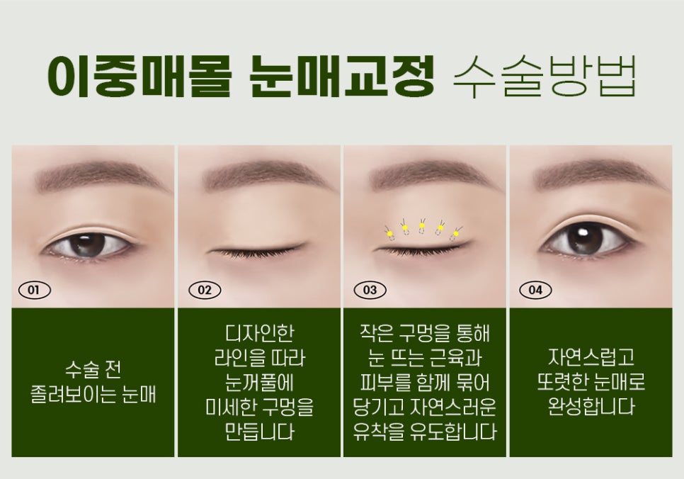 눈매교정 수술법, 절개 vs 비절개 나에게 맞는 수술법은? 관련 이미지 4
