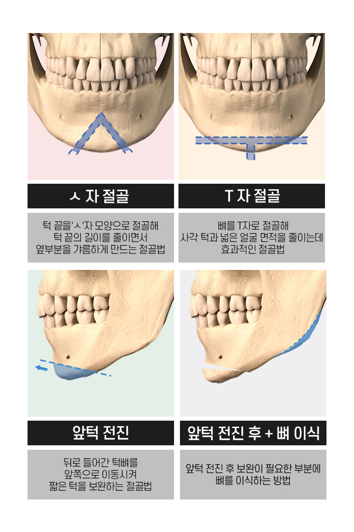 차별화된 방법으로 접근하는 남자 안면윤곽 관련 이미지 6