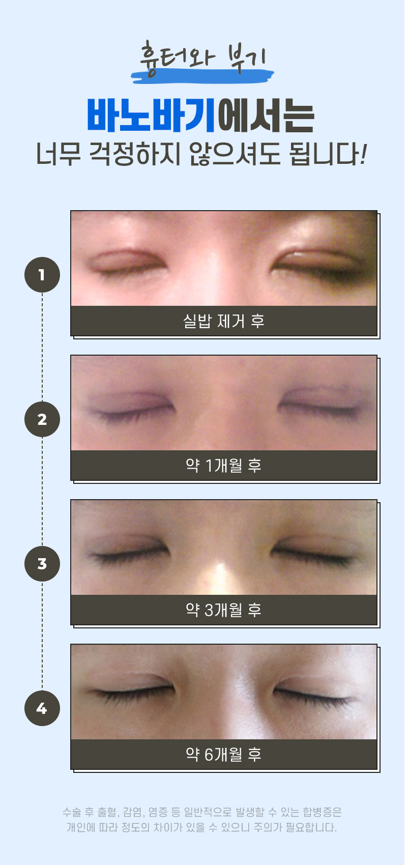 절개 쌍꺼풀, 원하는 라인으로 흉터 걱정 없이 한 번에 개선 관련 이미지 7