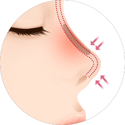 코재수술비용 코재수술병원 바노바기는 제대로 합니다! 관련 이미지 5