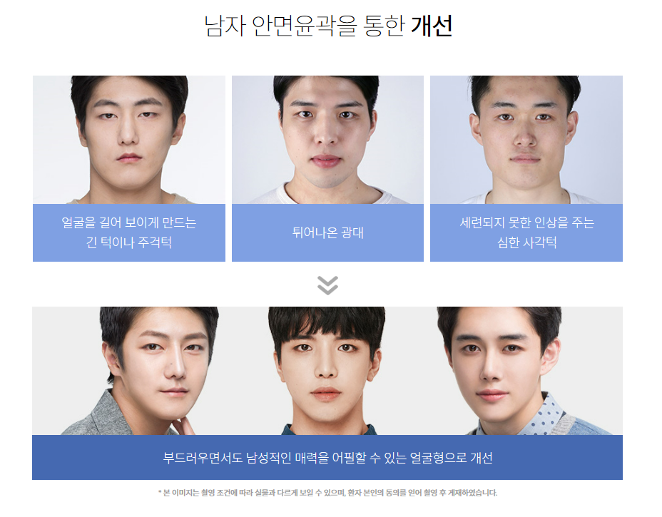 남자 안면윤곽의 핵심! 정확히 알아야 개선할 수 있다. 관련 이미지 4