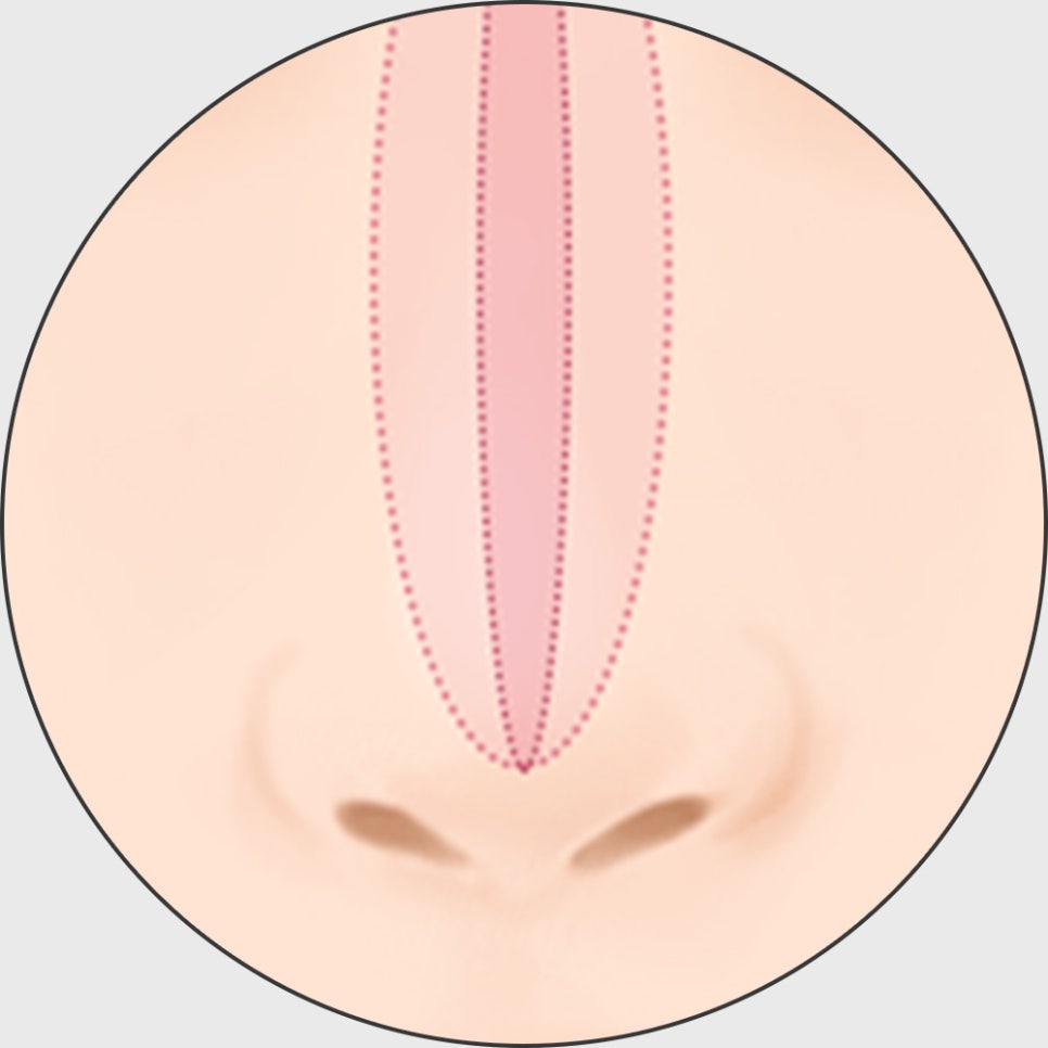 코 재수술, 적합한 시기에 원인에 따른 올바른 방법으로 개선해야 합니다! 관련 이미지 8