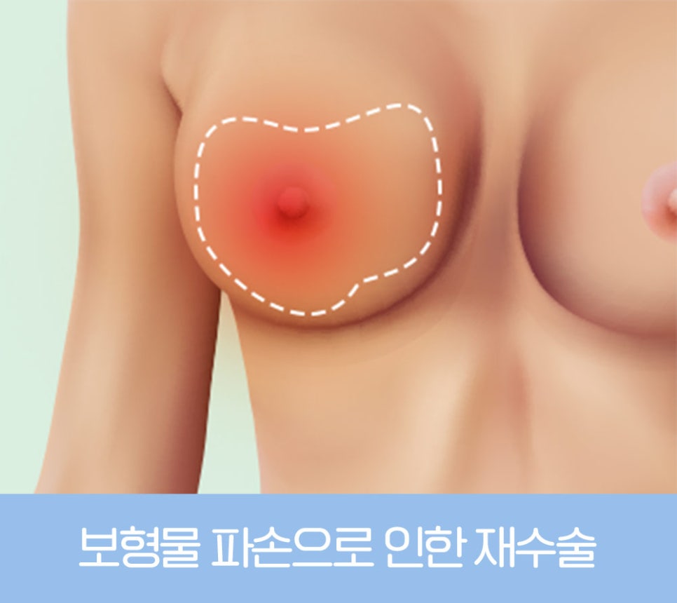 가슴 재수술, 원인에 따라 달라지는 개선 방법 관련 이미지 5
