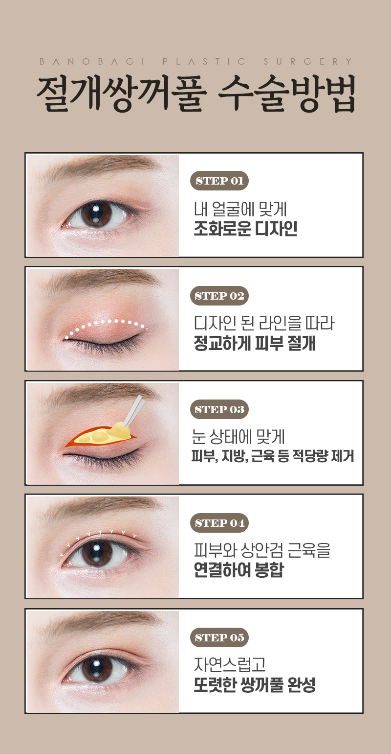 절개 쌍꺼풀의 수술법과 절개법이 필요한 경우 관련 이미지 3