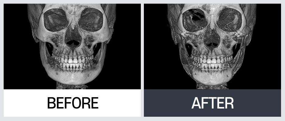 윤곽 재수술의 다양한 케이스와 수술 방법 관련 이미지 8