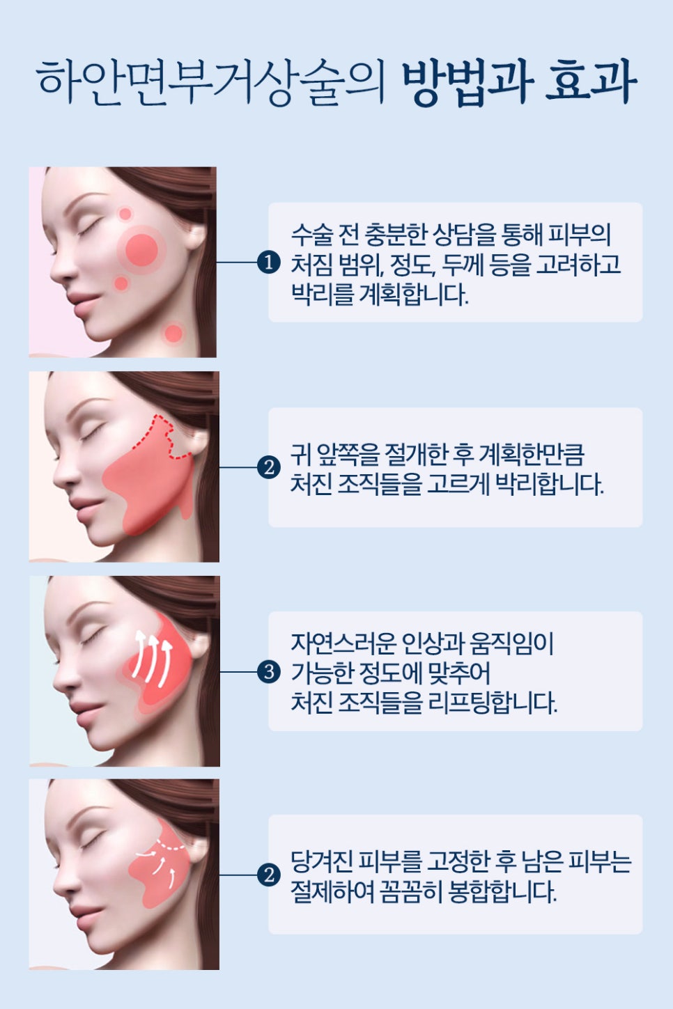 근막층까지 확실하게 당기는 바노바기 하안면부거상 관련 이미지 3