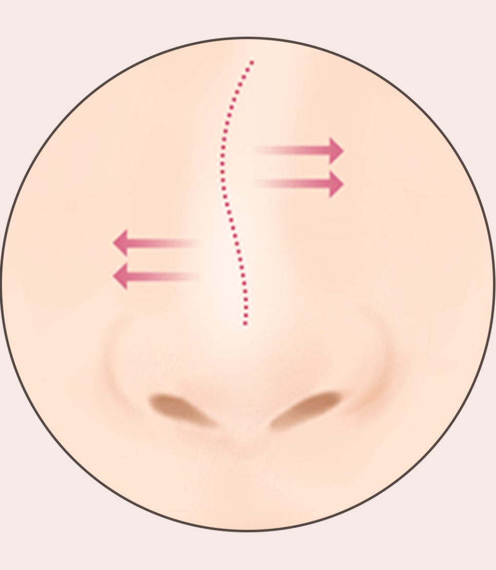 코 재수술의 다양한 원인과 개선 방법! 관련 이미지 11