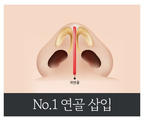 복코 성형, 뭉툭한 코를 세련되고 슬림한 코로 개선 관련 이미지 6