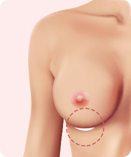 여의사 가슴 성형, 상담부터 수술까지 1:1 맞춤 케어 관련 이미지 8