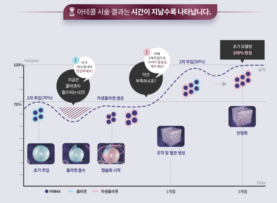 오래가는 아름다움, 반영구 필러 아테콜 관련 이미지 3