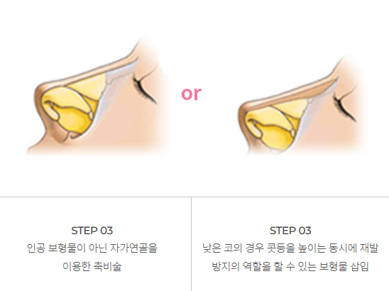 남자에게 맞는 코 성형과 개선 방법! 관련 이미지 8