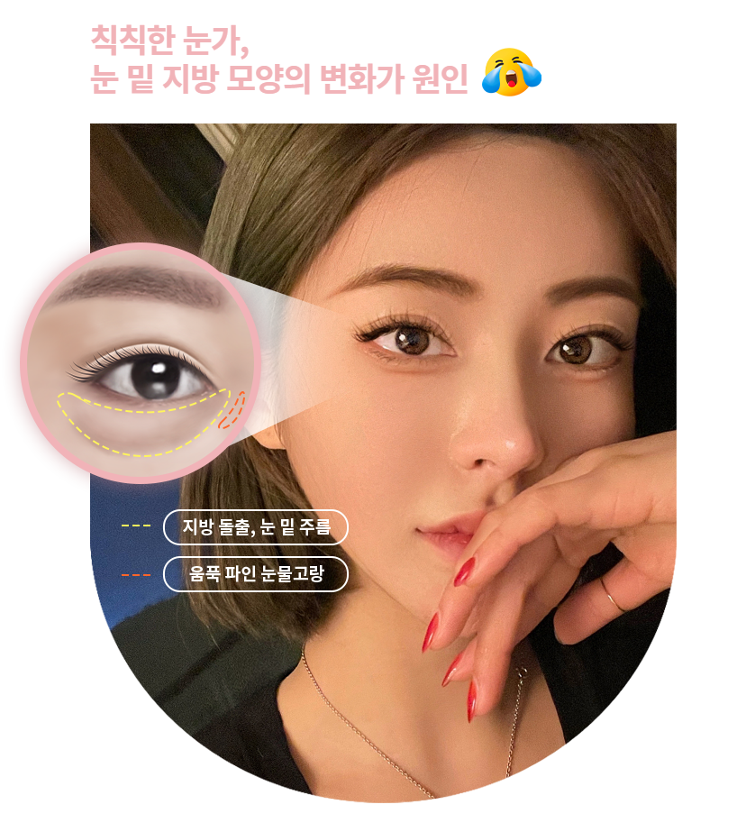 볼록하고 어두운 눈밑 정리하기! 눈밑지방재배치 관련 이미지 2