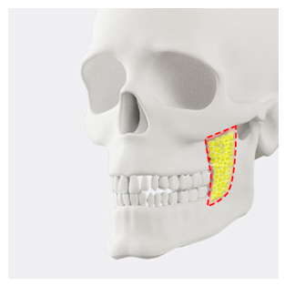 사각턱 수술 방법이 나뉘는 이유와 나에게 맞는 수술법은? 관련 이미지 5
