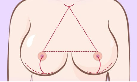 가슴처짐수술 회복과 흉터에 더욱 신경 써야 합니다. 관련 이미지 2