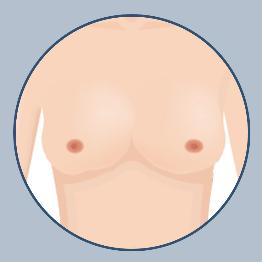 가슴 재수술, 원인에 맞는 정확한 수술법과 후 관리가 중요한 이유! 관련 이미지 4