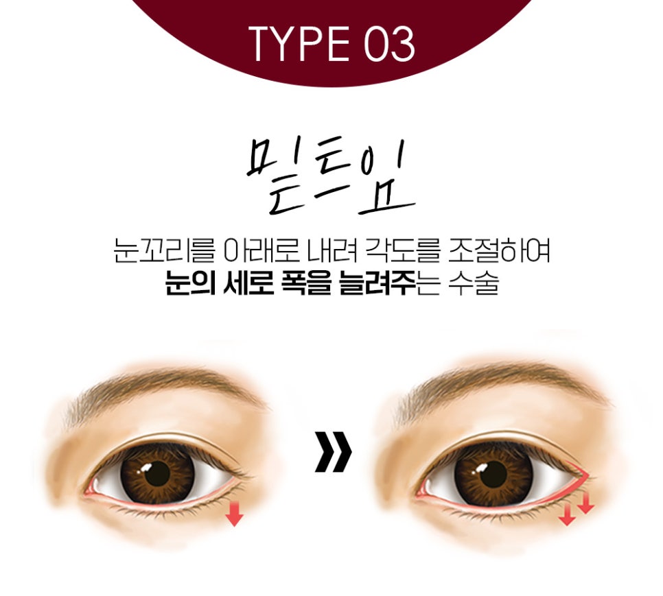 나에게 맞는 트임 성형으로 크고 또렷한 눈매로 개선 관련 이미지 6