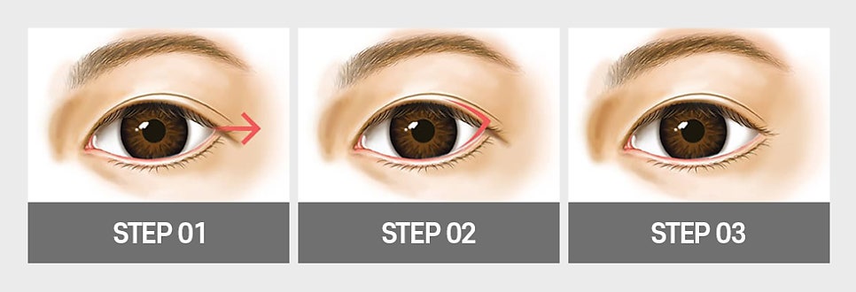 답답한 눈매를 또렷하고 시원하게 개선할 수 있는 트임 성형 방법! 관련 이미지 5