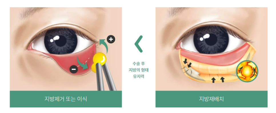 눈 밑 주름, 다크서클 눈 밑 지방재배치로 개선할 수 있습니다. 관련 이미지 3