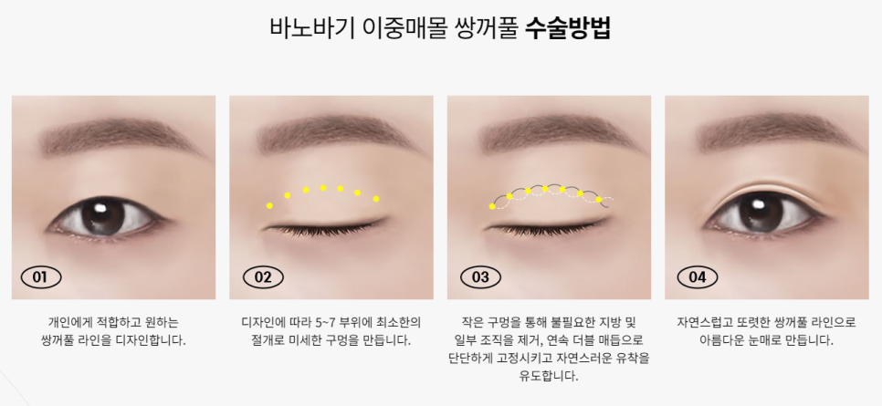 자연스러움의 끝판왕! 이중매몰 쌍꺼풀 관련 이미지 3