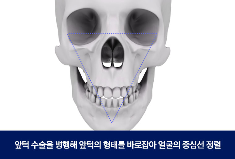안면비대칭, 정확한 원인 분석으로  한 번에 개선 관련 이미지 4