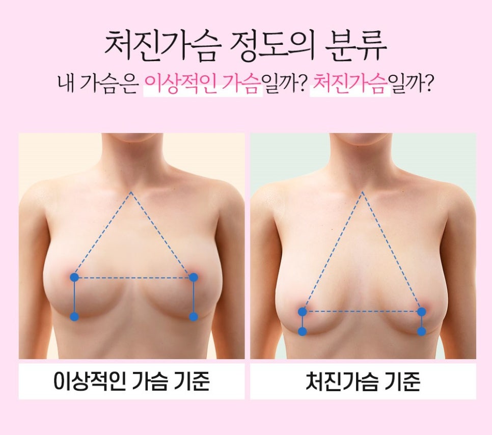 나도 처진 가슴일까? 유형에 따른 수술법과 개선 방법 관련 이미지 4