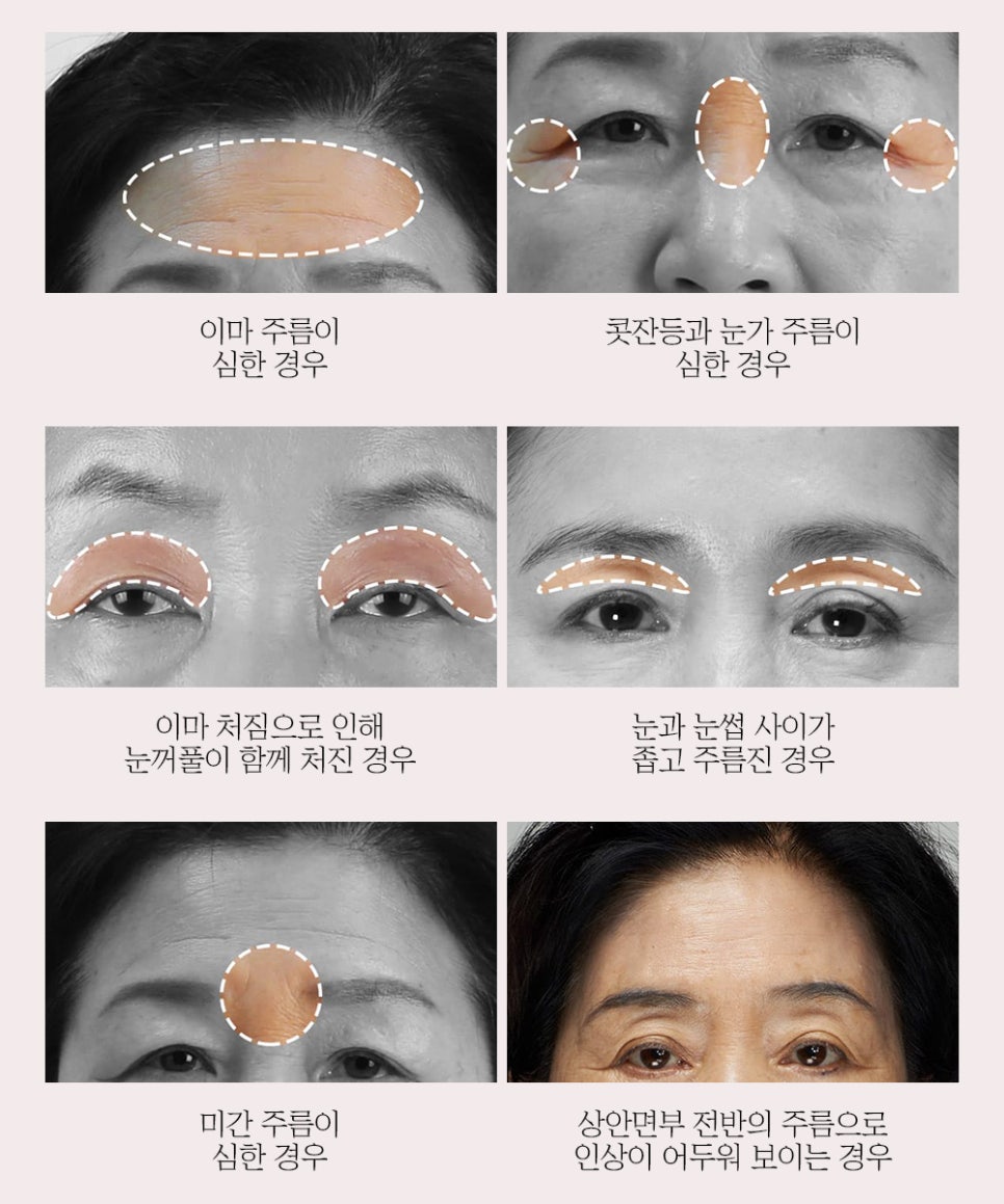 이마거상, 상안면부 노화 개선으로 더욱 밝아지는 인상 관련 이미지 3