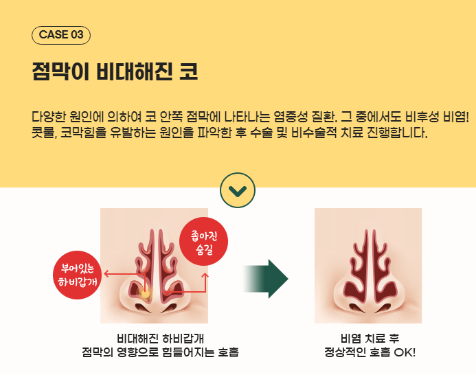 실비 적용되는 예쁜 코, 기능코성형 관련 이미지 4